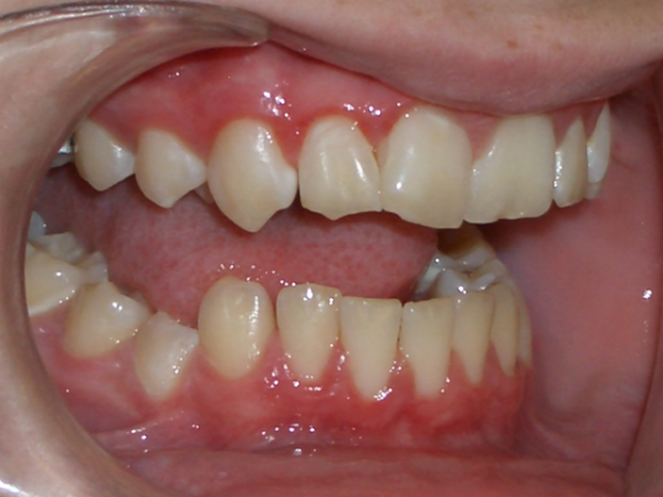 Insight Into Dental Implant Instances